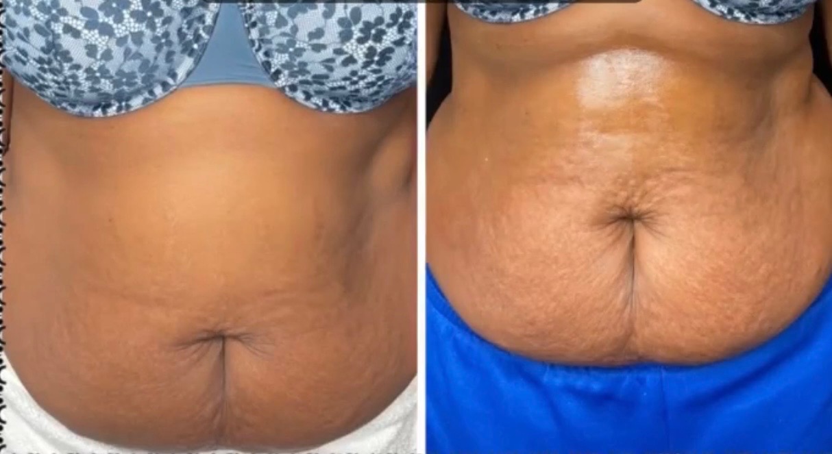 Postpartum sculpting